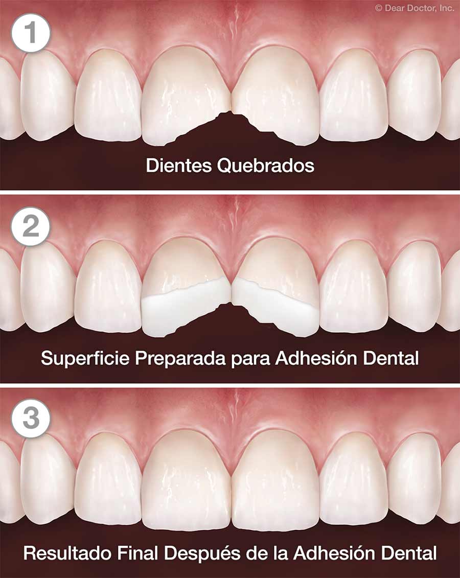 Adhesión Dental - Paso a Paso.