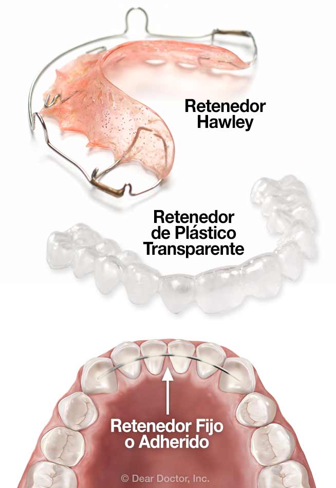 tetraedro Pedicab patrón Cuidado Post Ortodoncia - Dentist Downers Grove, IL - Dental Spanish  Education Library