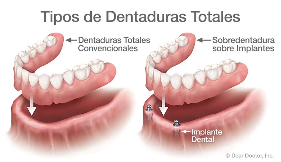 Tipos de Dentaduras Totales.