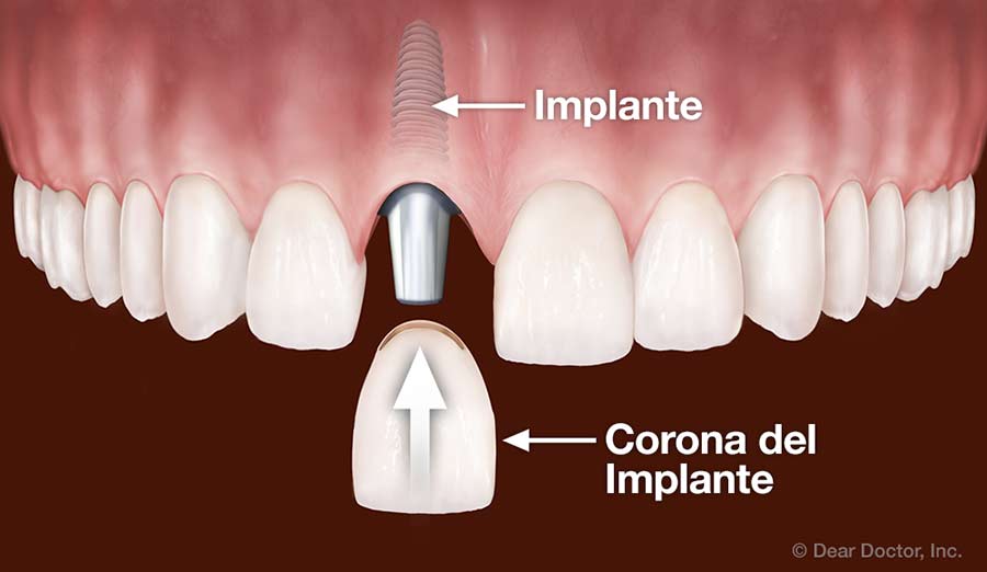 Corona del implante.