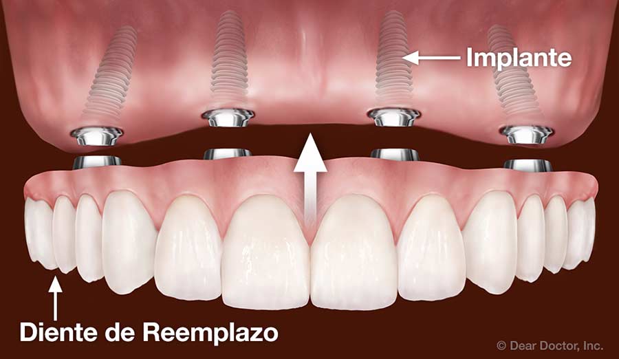 astronomía Perfecto Reducción Implantes Dentales - Dentist Downers Grove, IL - Dental Spanish Education  Library