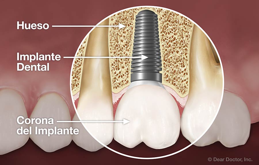 Implantes dentales.