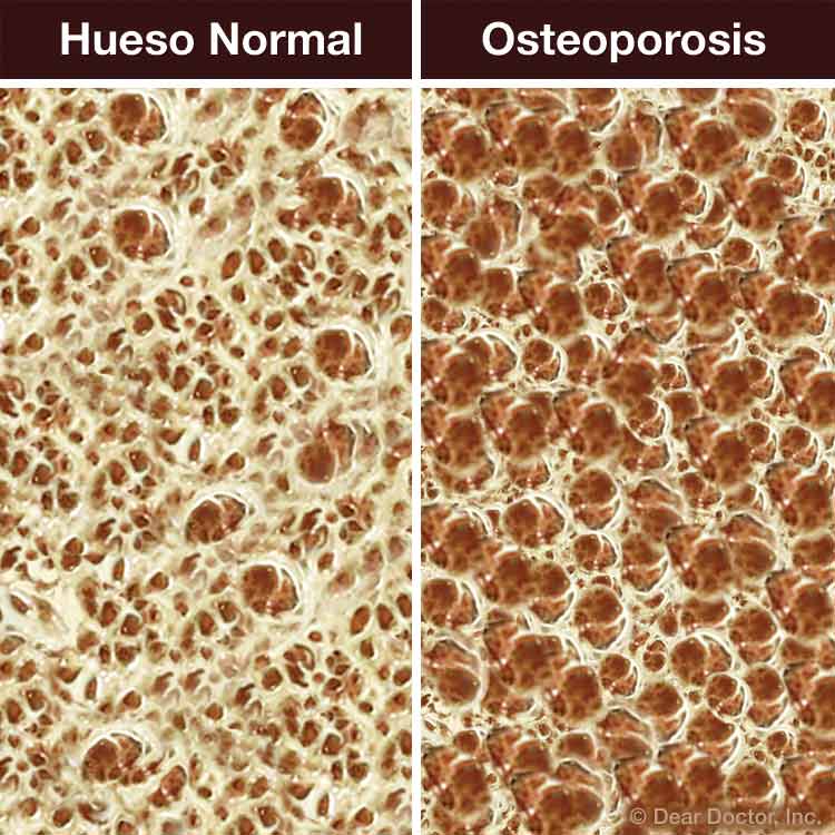 Hueso normal vs Osteoporosis.