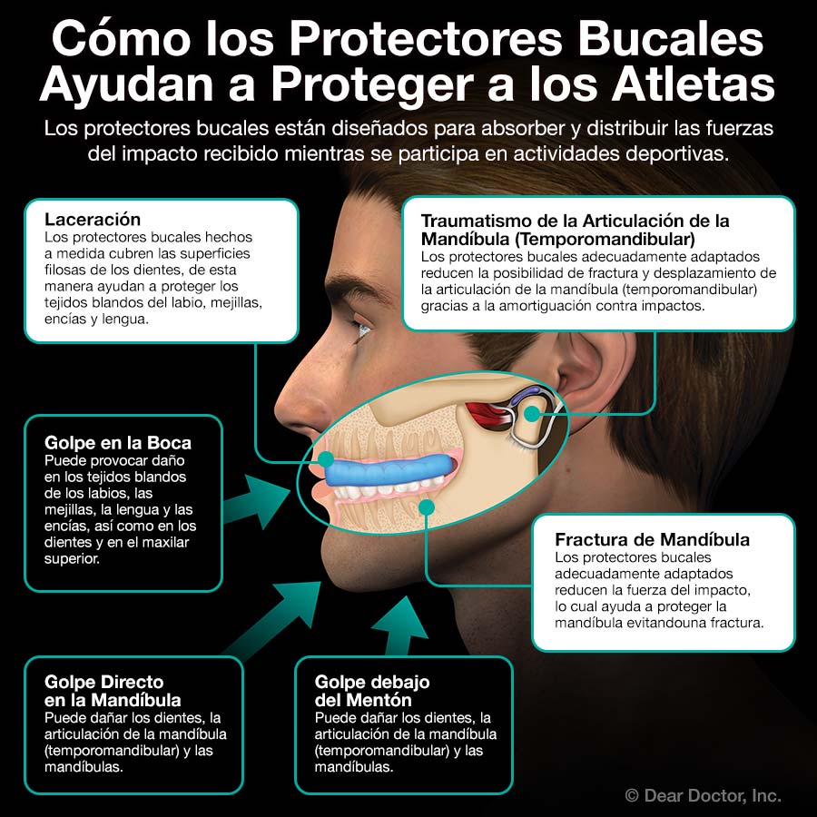 Kentop Cubitos Prótesis Bote para plástico Protector bucal para Dientes Pasador knirscher Carril Lata （ Color al Azar ） 