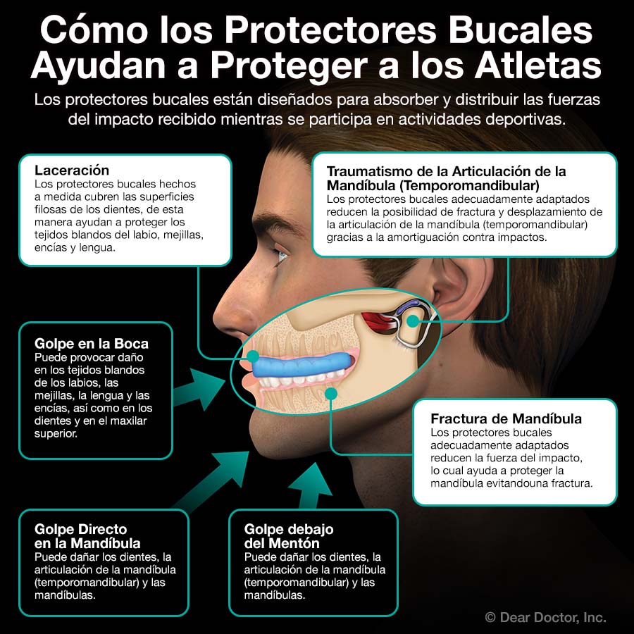 obispo bolita lector Protectores Bucales para Adultos | Advanced Smiles Dental, P.A.