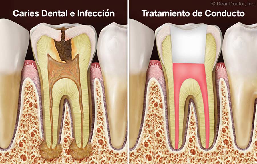 Tratamiento de Conducto.