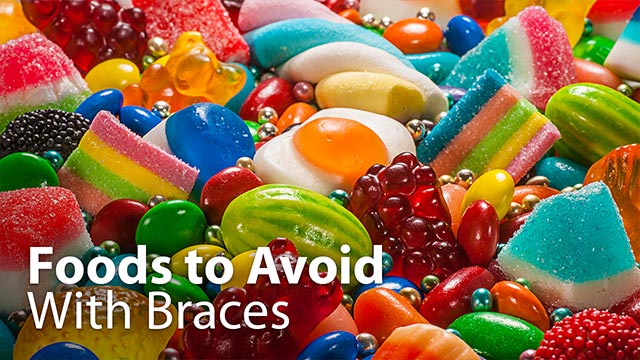 Foods to Avoid With Braces Video