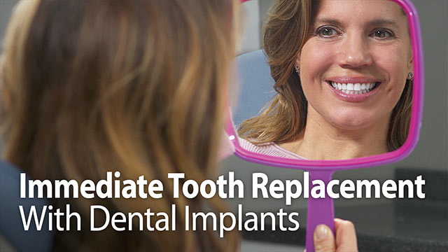 Immediate Tooth Replacement With Dental Implants Video