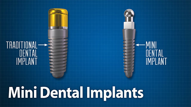 Mini Dental Implants Video