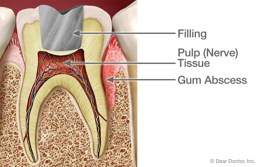 Gum abscess.