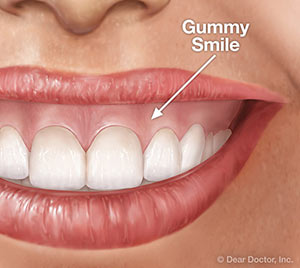 Gummy Smiles
