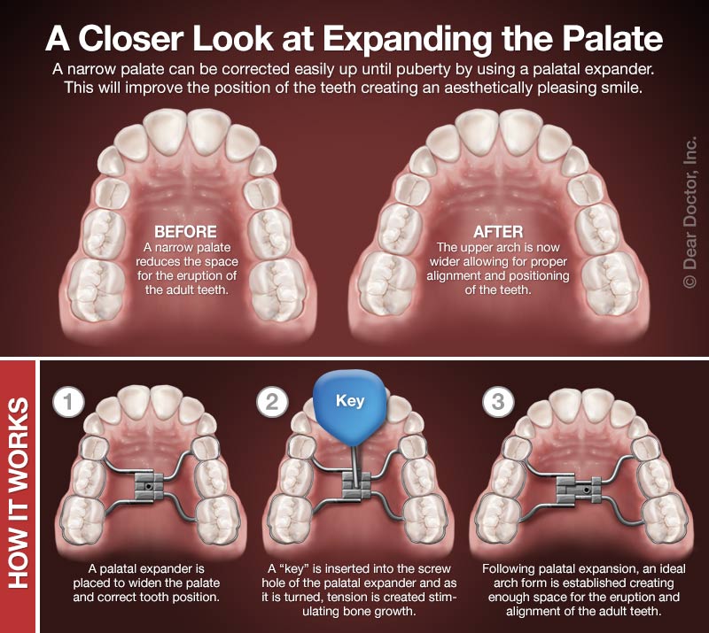 How palatal expanders work.