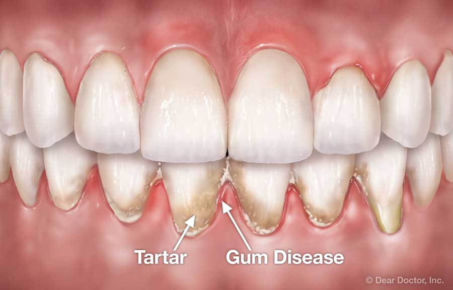 Tooth Wear.