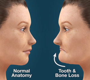 Top Reasons to Choose Dental Implants