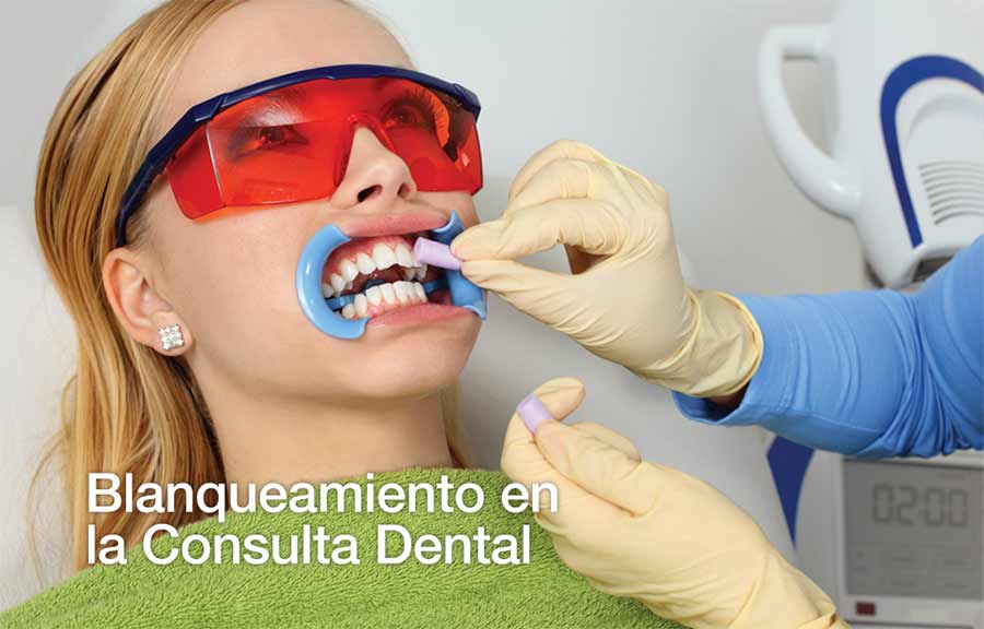 Blanqueamiento en la consulta dental.