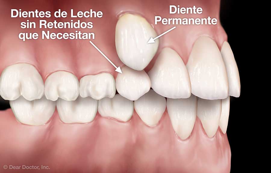 Dientes de Leche sin Retenidos que Necesitan Extracción.