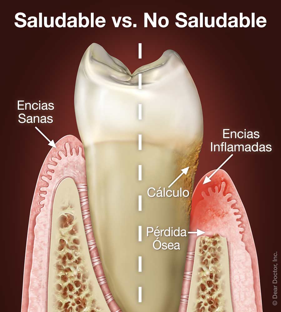 Enfermedad periodontal.