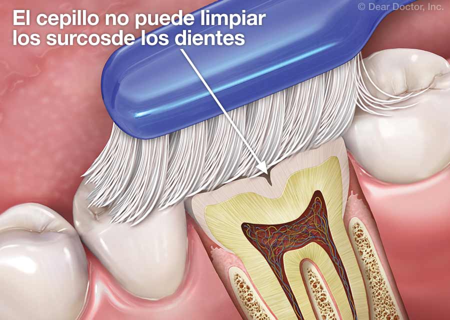 El cepillo no puede limpiar los surcosde los dientes.