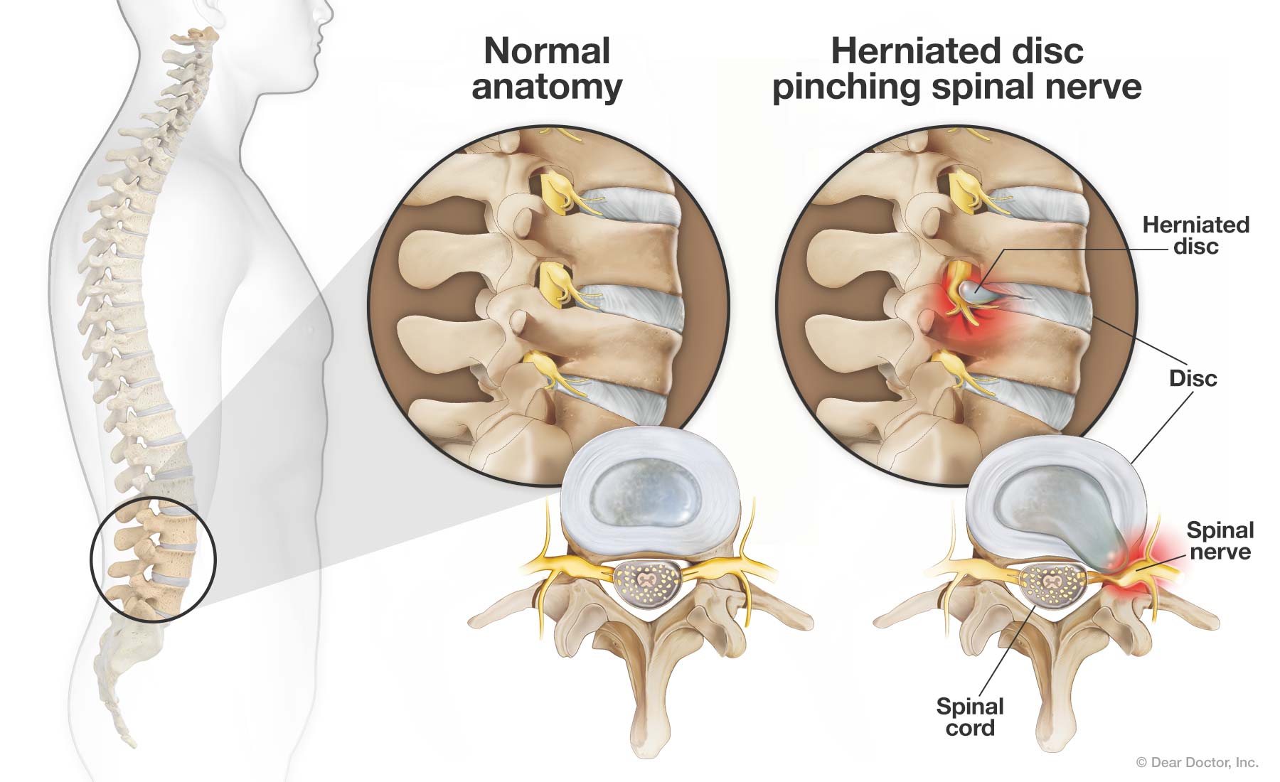 Pinched Nerves and What to Do About Them