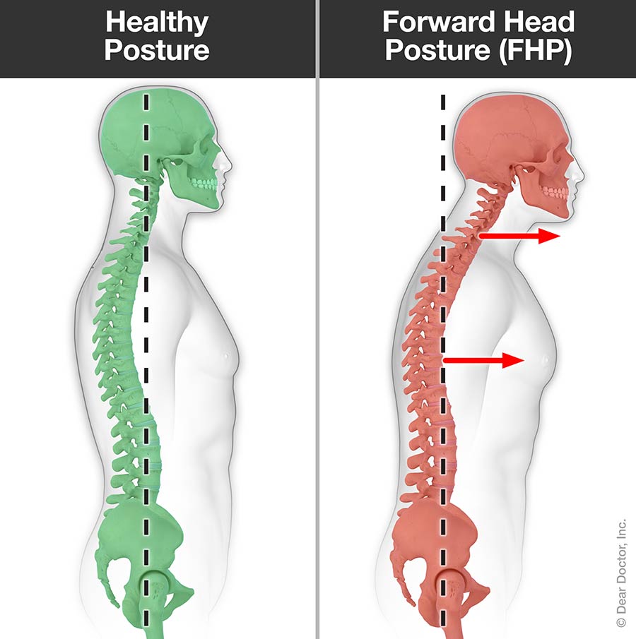 Fhp Back Posture Problems