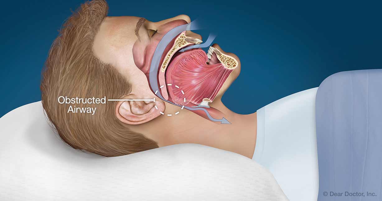 Sleep Apnea