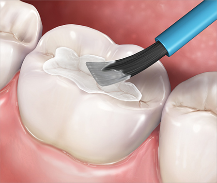 Dental Sealants