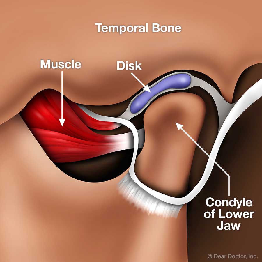 TMJ Joint.