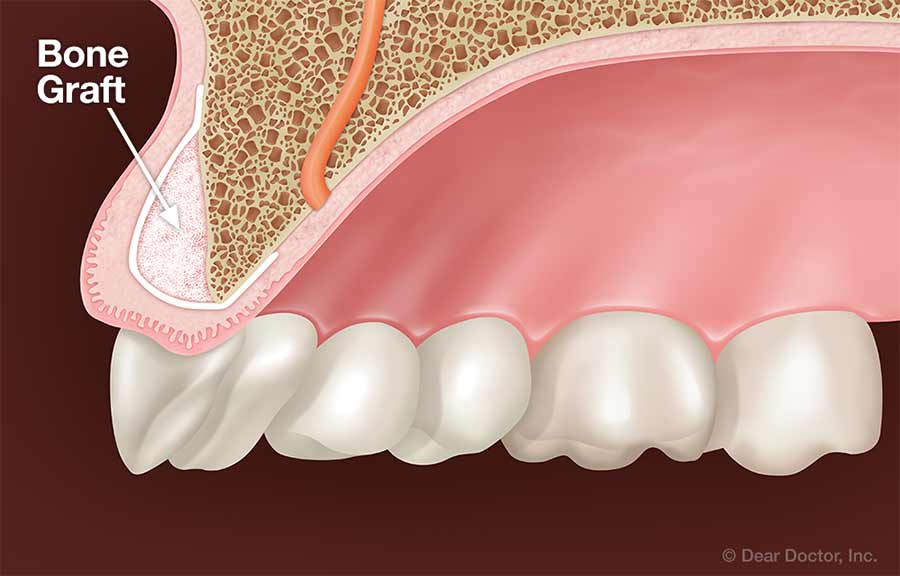 Bone graft.