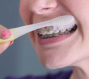 Brushing and Flossing with Braces.