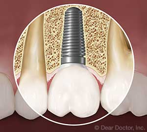 Implantes Dentales.