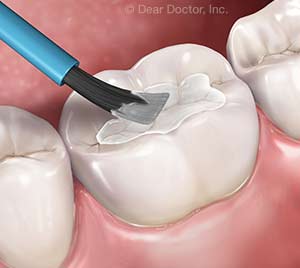 Dental Sealants.