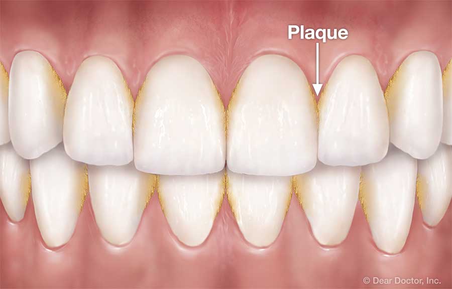 Plaque between teeth.