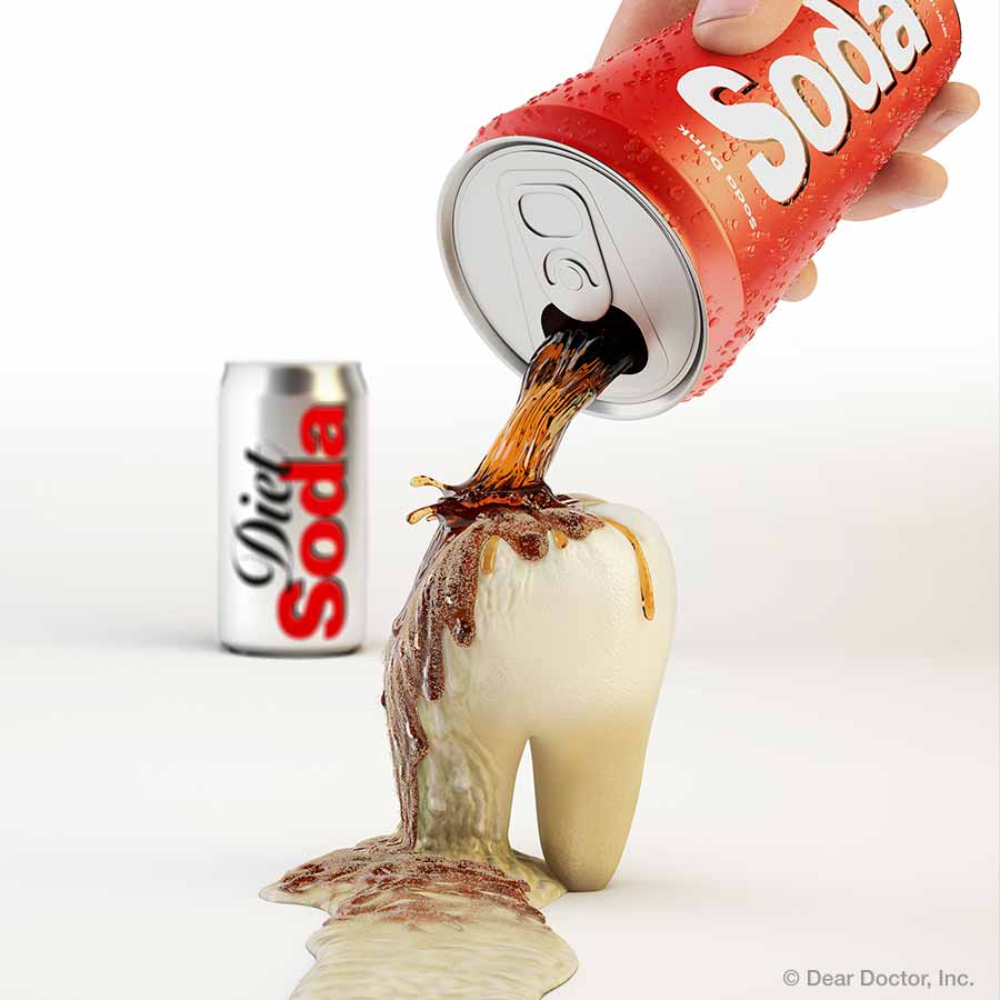 Soda and tooth erosion.