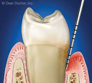 Enfermedad Periodontal (de Encías).