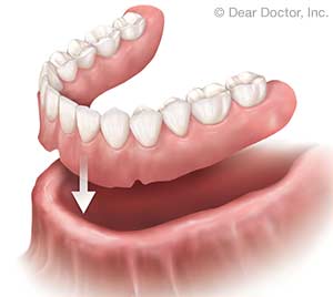 Removable Dentures.