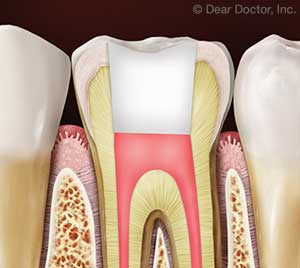 Root Canal Treatment.