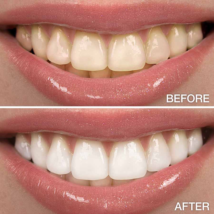 Teeth Whitening Before and After.