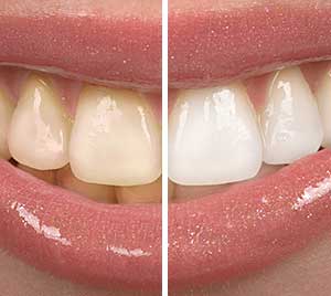 Teeth Whitening.