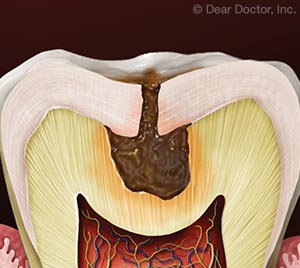 Prevención de Caries.