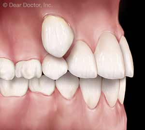 Extracción de Dientes.