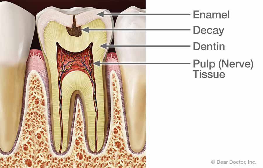 Tooth Decay.