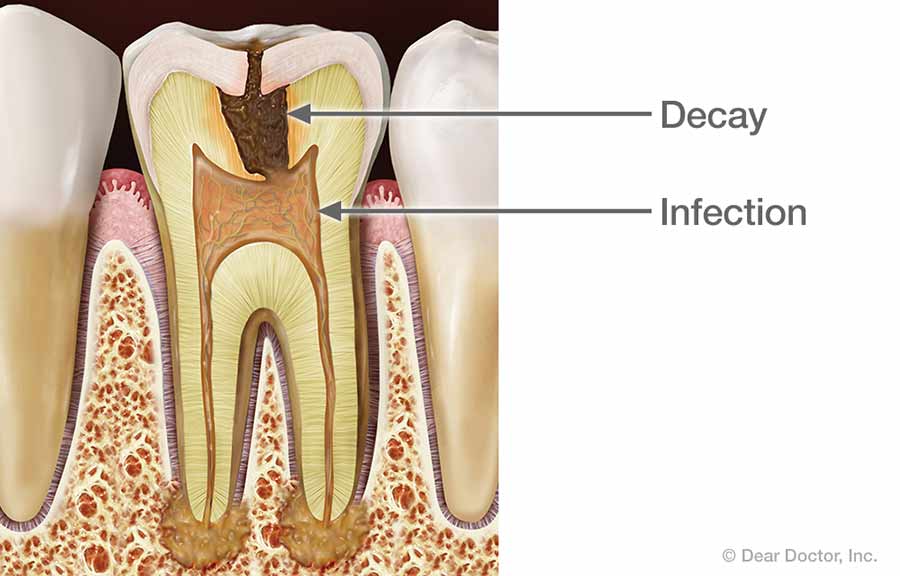 Tooth Infection.