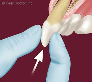 Traumatic Dental Injuries.