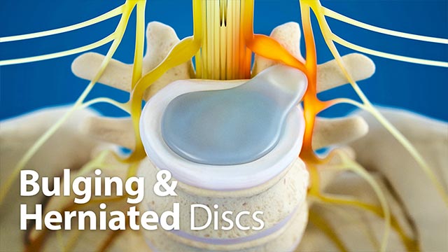 Bulging and Herniated Discs Video