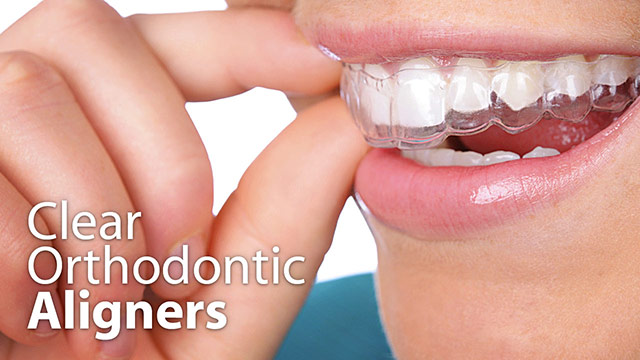 Clear Orthodontic Aligners Video