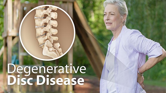 Degenerative Disc Disease Video
