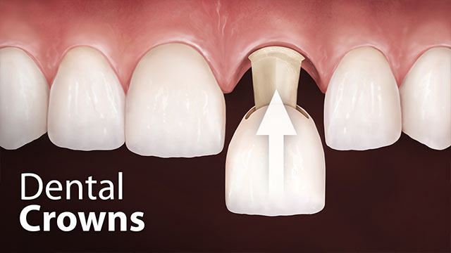 Dental Crowns Video