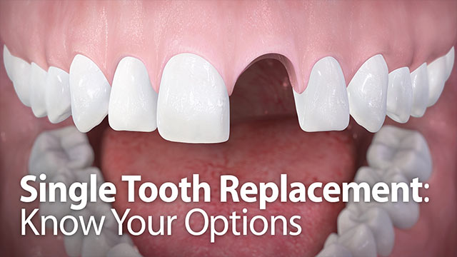 Single Tooth Replacement Video