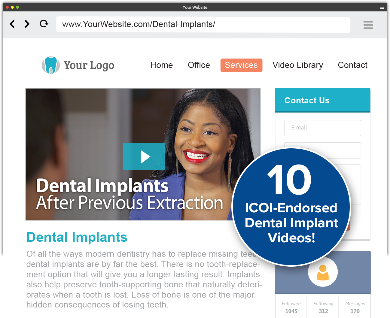 Dental Implant Videos